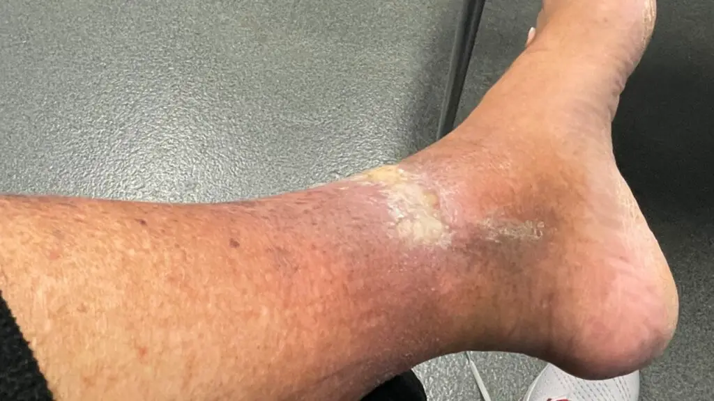 Wrestling icon Jim Ross shows his leg where he beat skin cancer